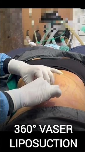 Tummy Liposuction Surgery | Stubborn Fat Removal Without Gym? Before & After Results