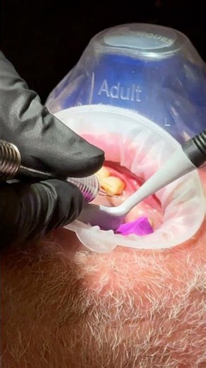 Maxillary Arch Full-Mouth Extraction in the Esthetic Zone | 1930E Clinical