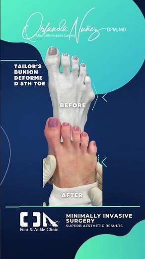 Tailor's Bunion Deformed 5th toe - Minimally Invasive Surgery (MIS) Correction