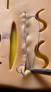 76K views · 378 reactions | Running subcuticular suture (part 2) | Dermhacks | Facebook