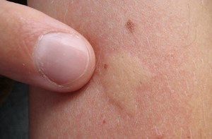 Les pompes à venin. Guide complet