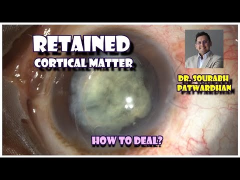 83 retained Cortical (cortex) matter behind IOL -Dr Sourabh Patwardhan How to deal