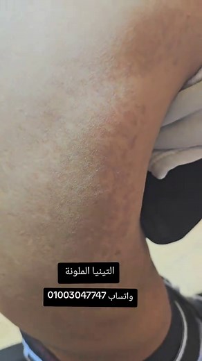 التينيا الملونة: علاج فوري وفعال للمشكلة الجلدية
