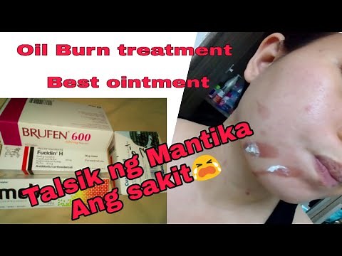 Oil Burn,, Best ointment, First aid, (Paano Gamotin talsik ng mantika)