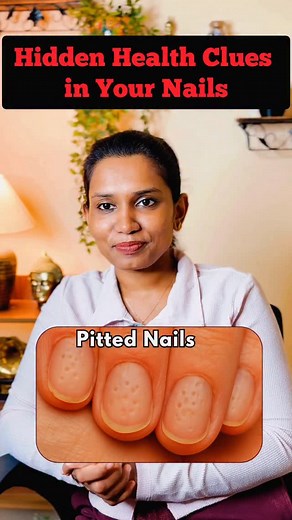 Your nails can reveal more than you think! Pitting, ridges, discoloration or thickening — each could be a sign of an underlying health issue like psoriasis, fungal infection or nutritional imbalance. Listen to what your nails are trying to tell you! (nail changes, nail health, psoriasis nails, psoriatic arthritis nails, fungal nail infection, nail discoloration, nail pitting, ridged nails, nail care, Ayurveda for nail problems, nail diagnosis, health through nails, nail signs of disease, nail pr