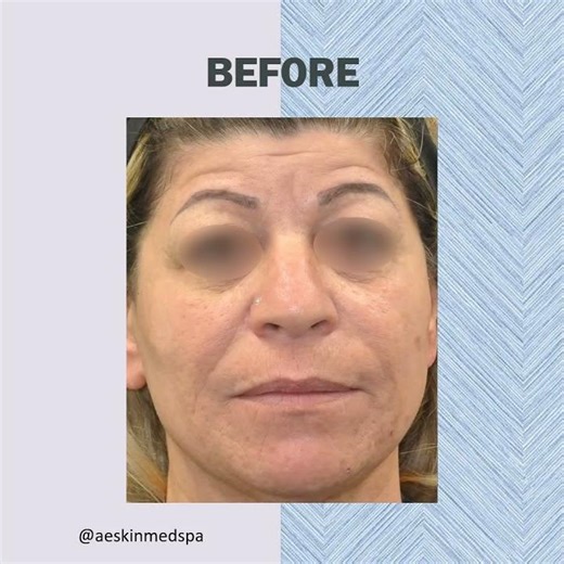 AMAZING results from a Voluma treatment (4)