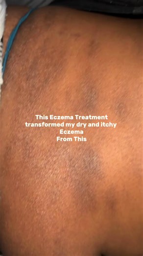 Eczema Healing: Transform Your Skin Naturally