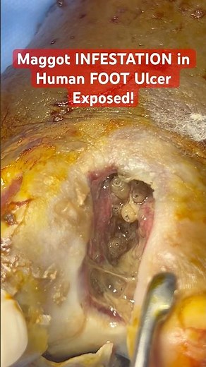 Maggot INFESTATION in Human FOOT Ulcer Exposed! Facts #shortsfeed #shorts