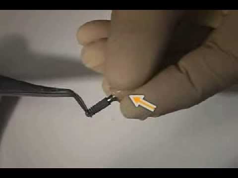 How a crown is fixed on an Implant - Abutment