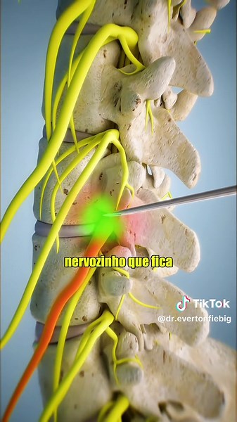 Solução para Dor Ciática: Tratamento Eficaz