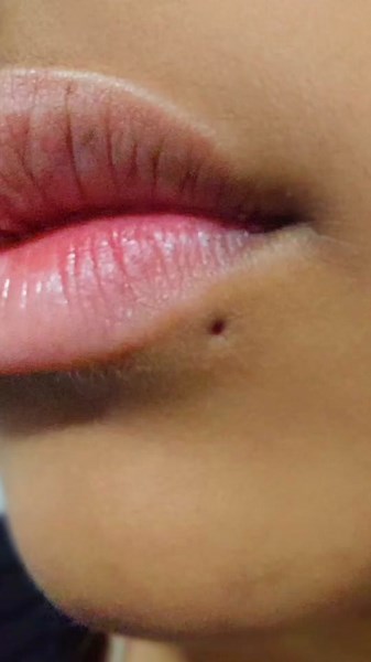 Labret Lateral Cicatrizado: A Importância da Cicatrização
