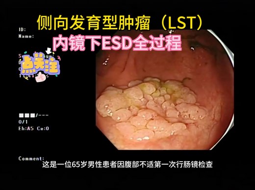 侧向发育型肿瘤（LST）内镜下ESD全过程