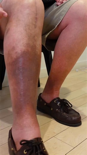 Healthy Legs Feel Better! State-of-the-art vein treatments from nationally accredited doctors. ✅ Covered by insurance ✅ Minimally-Invasive ✅ Board-Certified Vein Doctors ✅ 10,000 5-Star Reviews with 98% Patient Satisfaction | Metro Vein Centers