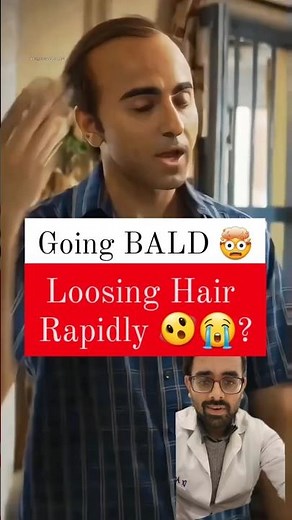 Male pattern baldness, also known as androgenetic alopecia #hairloss, #hairfall, #malebaldness