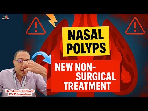 New Treatment for Nasal Polyps Without Surgery | Latest Medical Advances Explained