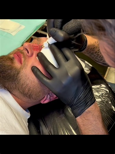 Electrocautery scarification time lapse. Total procedure about 15min. The best part about this type of scarring is no bleeding. #scarificationartist #bodymod #tattooartist @painfulpleasures @afterinked2007 @needlerockbodyart @saniderm