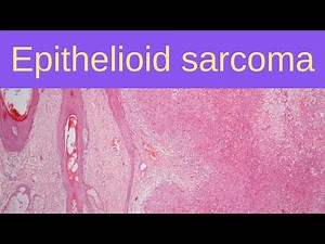 Epithelioid Sarcoma - Pathology mini tutorials