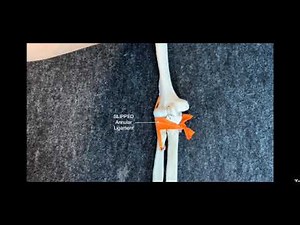 How to do a Nursemaid's Elbow Reduction