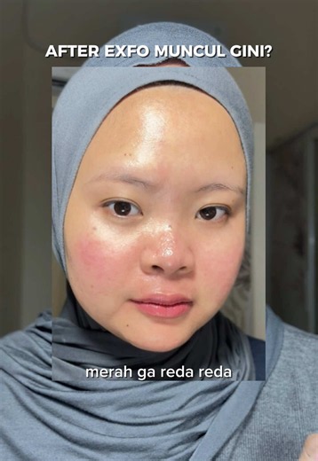 Eksfoliasi Wajah Gentle: Cara Ganti Exfo untuk Kulit Berjerawat