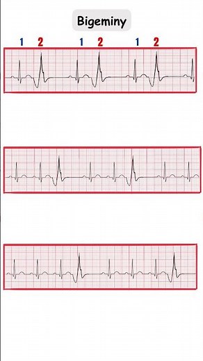 Premature Contractions/Bigeminy, Trigeminy, Quadrigeminy/ECGMadeEasy #ecg #doctor #medicine #cardio