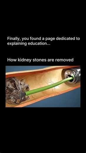 Explaining Education on Instagram: "Kidney stones can be removed in different ways depending on their size and location. Small stones often pass naturally through urine with the help of plenty of water and pain-relief medicines. For larger stones, doctors may use shock wave lithotripsy (SWL), where strong sound waves break the stone into tiny pieces that can pass through urine. If the stone is stuck or very large, procedures like ureteroscopy (using a thin tube with a camera to remove or break t