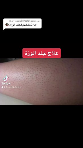 Reply to @roro11072019 علاج جلد الوزة #CinderellaMovie #dr_rasha_nasser #askthedoctor #skincare #dermatologist