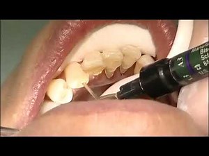 Clinical case using everStick® Perio