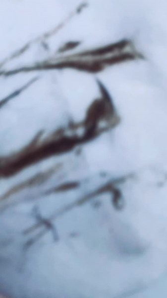 Extractions Dermaplaning = A match made in heaven