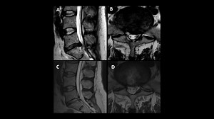 Full Endoscopic Interlaminar Approach for Paracentral L5-S1 Disc Herniation