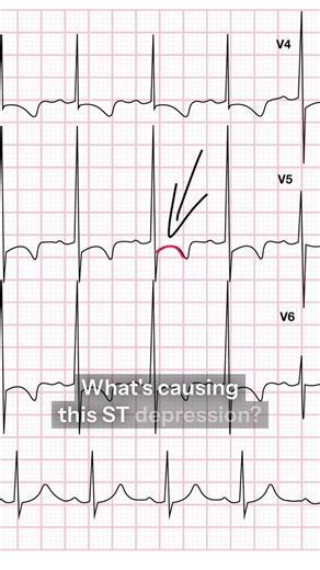 Understanding ST Depression Causes in Cardiology