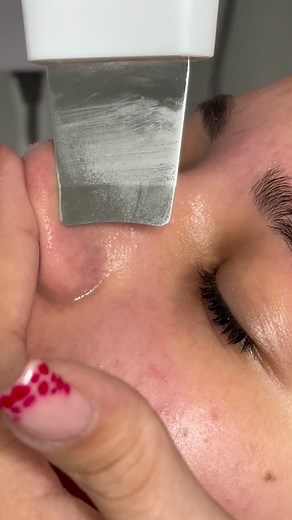 8.2K views | Tout savoir sur les comédons et leur extraction! ...