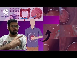 YOLO11 Endoscopy Image Analysis: Train Custom AI Model for Medical Image Segmentation