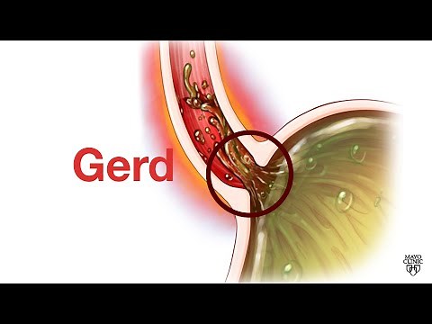Mayo Clinic Minute - GERD is not 'just' heartburn