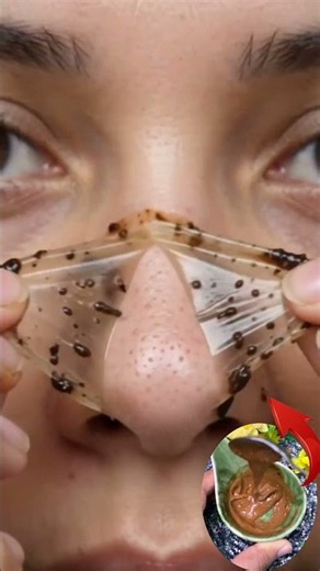 Remove Blackheads Permanently At Home Blackheads Removal Easy Tips ✨ Clear Glass Skin #ytshorts