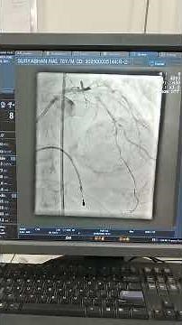 rota and ivus guided ptca to LAD in acute coronary syndrome Pt