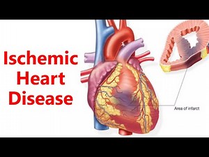 Ischemic Heart disease Explained: Causes, Symptoms, Diagnosis & Treatment