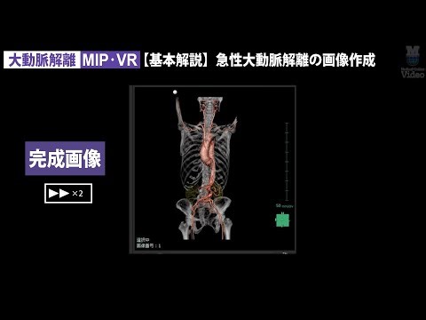 3D画像製作 大動脈解離 MPR・MIP・VR ｜ 3D画像作成（CT） 胸部 ｜ Medical*Online Video（プレビュー）