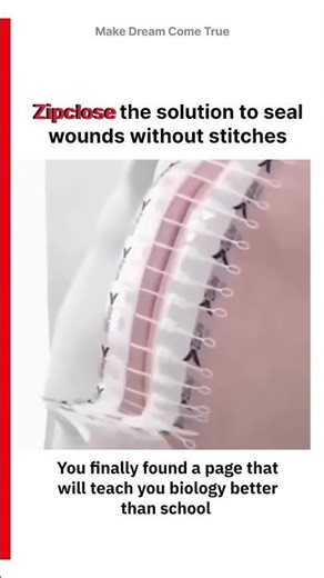 🤐 Zipclose the solution to seal wounds without stitches 🪡 | MDCT