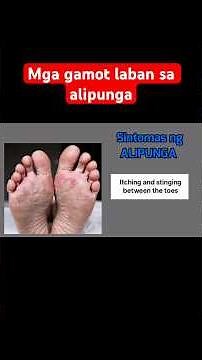Gamot sa alipunga sa paa | Canesten, Daktarin, Nizoral cream para sa alipunga