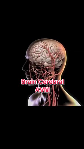 Let's dive into the realm of cerebral AVMs and their treatment options. #neurology #neurologist #brain #losangeles #pasadena #education #interventionalneuroradiology #doctor #topdoctor #DrWazni #Medicine #information #braindoctor #lifestyle #health #healthyLiving #arterialvenousmalformation