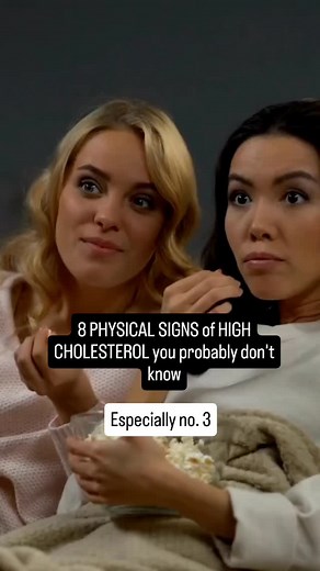 Here are 8 physical signs that might be associated with high cholesterol, some of which might be less well-known: 1. *Xanthelasma*: Small, yellowish patches or bumps on the skin, particularly around the eyes, due to cholesterol deposits. 2. *Corneal Arcus*: A white, gray, or blue ring around the cornea, which can be a sign of high cholesterol in younger individuals. 3. *Tendinous Xanthomas*: Deposits of cholesterol in tendons, often appearing as nodules or swelling, particularly in the Achilles