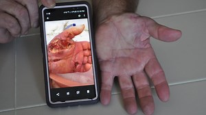 Vibrio: Each year people are infected with the deadly bacteria