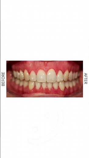 Offener Biss mit Invisalign? So funktioniert die Behandlung wirklich!