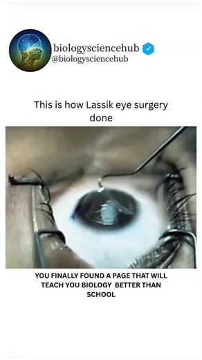 BIOLOGY UNIVERSE | This is how LASIK eye surgery is done—quick, precise, and life-changing ✨ LASIK is a modern vision-correction procedure designed to reduce... | Instagram