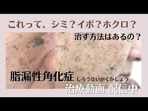 【治療映像あり】歳を重ねて出る盛り上がったシミ『脂漏性角化症』の治療法を紹介