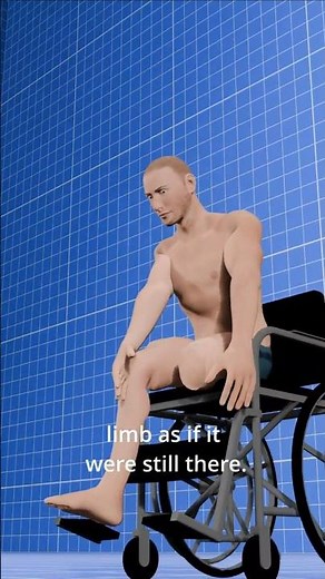 The phantom limb pain phenomenal