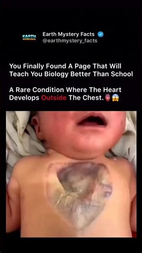 Baby Born With Heart Outside The Chest 😱 | Rare Condition Explained #humanbodyfacts
