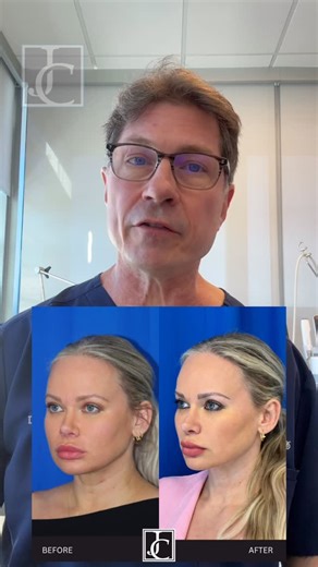 Dr Jay Calvert on Instagram: "The midface lift is a powerful operation, and one that I perform very frequently. It really is the key to rejuvenating the Peri-orbital region and the cheek. I perform this operation endoscopically through a small incision in the temple behind the hairline. For more information, check out the Beverly Hills Plastic Surgery podcast. I have many episodes dedicated to the mid face lift. You can see it on my Instagram feed. Happy to answer any questions about the mid fac