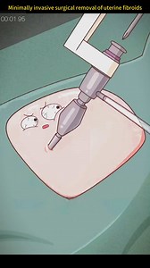 92K views · 472 reactions | #uterine #fibroids #minimally #invasive #surgical #removal #foryou #fypシ #sciencefacts #mathematics#physics#life #subject #science #quantumphysics, #fyp #foryou #tiktok #lnteresting#science#physics | Sience | Facebook