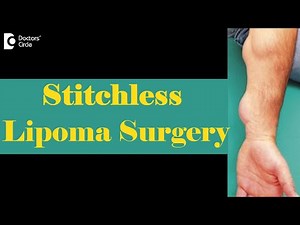 What is Stitchless Lipoma Surgery?|Multiple Lipoma Treatment-Dr. Sahebgowda Shetty | Doctors' Circle